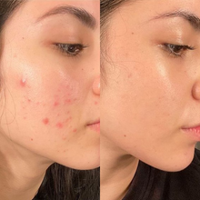 Anti Acne & Glowing | Vitamin E, Vitamin C, Salicylic acid | Flos skincare